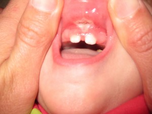 Appearance of lip after laser release of lip-tie.