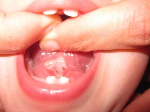 Appearance of tongue after laser tongue-tie release